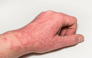 Eczema Study (12 Months)